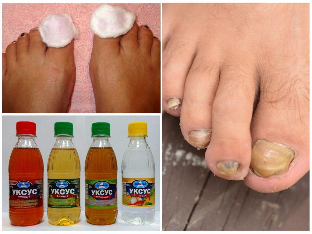 Как вылечить грибок ногтей на ногах в домашних условиях