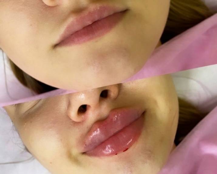 Почему появляются синяки после увеличения губ? особенности удаления гематом после увеличения губ гиалуроновой кислотой