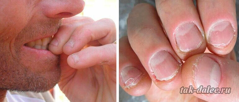 Почему люди кусают ногти? 3 любопытных факта об этой вредной привычке | playboy