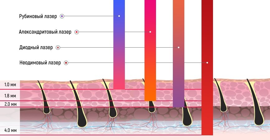Лазерная эпиляция схема процедур