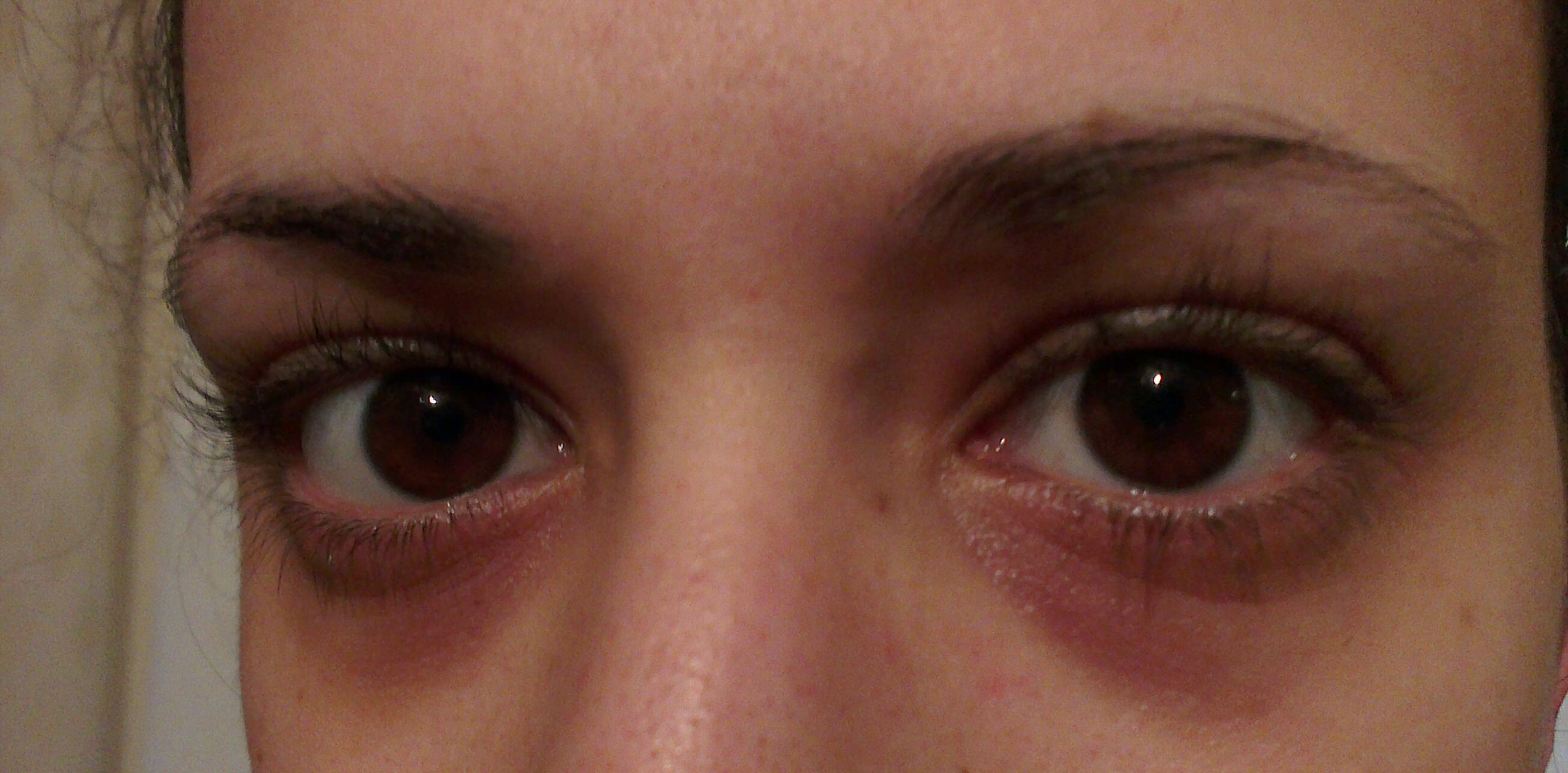 Сотрясение глаза. Красные синички под глазами. Красные синяки под глазами. Коричневая кожа вокруг глаз.
