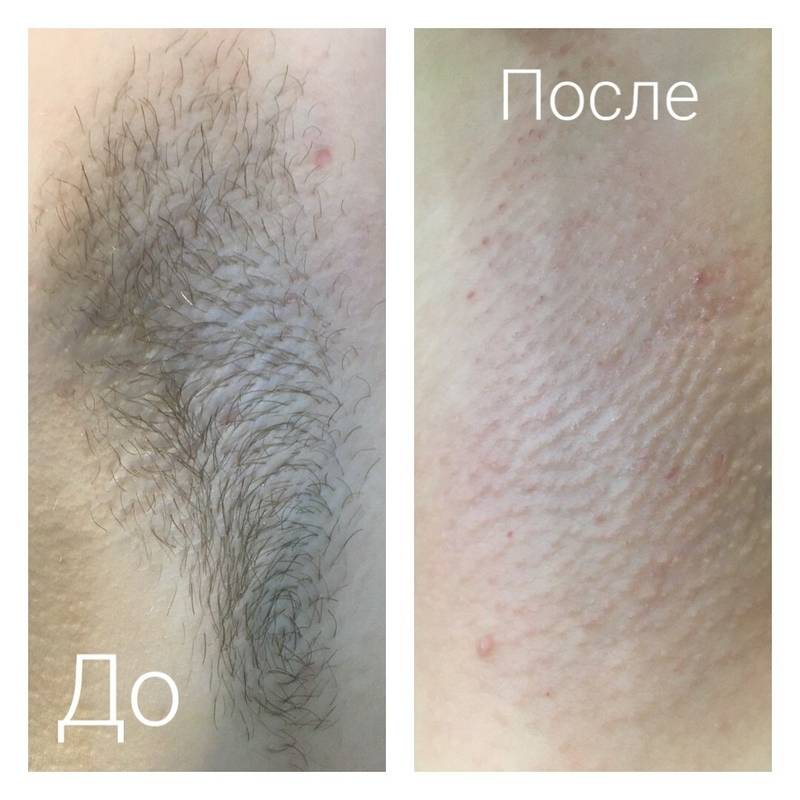 Все, что вы хотели знать об эпиляции, но не знали, у кого спросить. часть 2