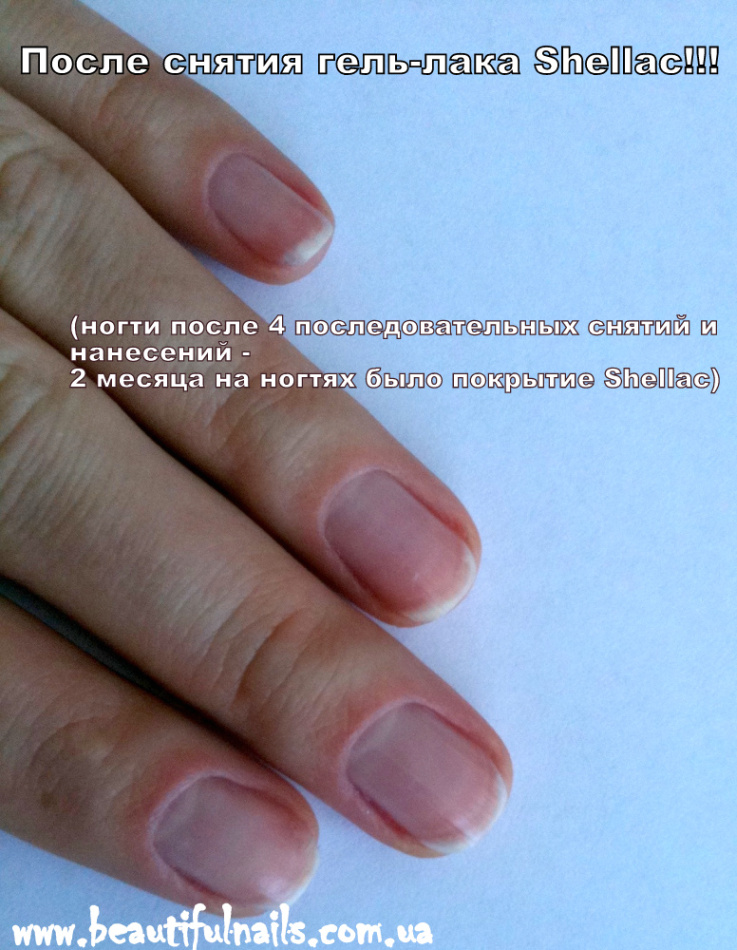 Проблема ногтей: как восстановить их после длительного покрытия шеллаком