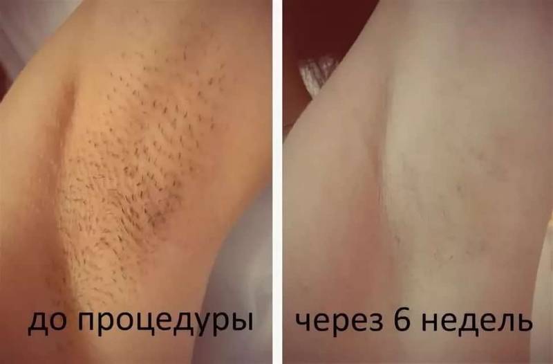 Как окончательно остановить рост волос с помощью восковой эпиляции?