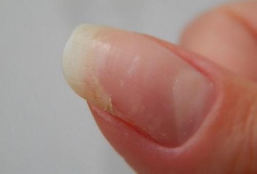 Трофическая язва: гнойно-некротическая рана на коже, часто возникающая при прогрессировании варикозафлебологический центр "антирефлюкс"