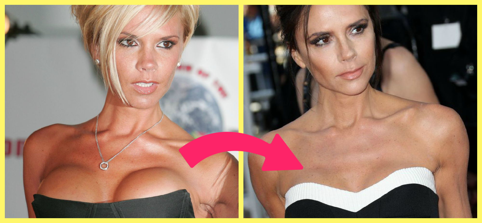 Пластика груди:  фото до и после