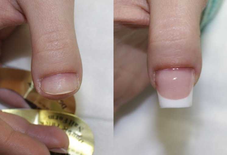Скобы и пластины от вросшего и скрученного ногтя | центр подологии и остеопатии татьяны красюк