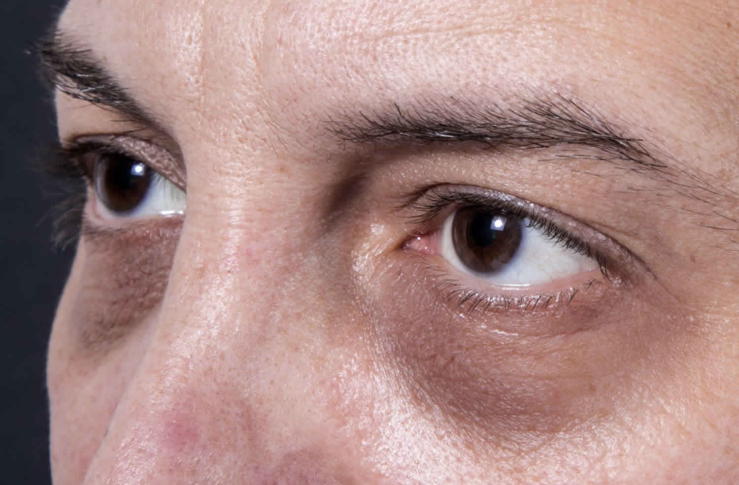 Белые круги под глазами: причина, диагностика, фото и лечение