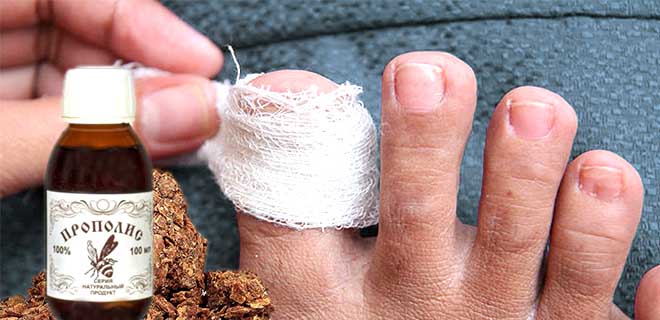Как лечить грибок ногтей на ногах народными средствами