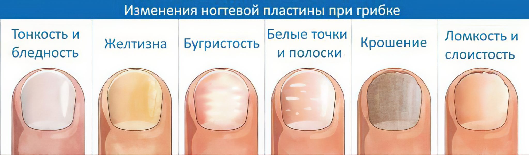 Грибковые заболевания ногтей схема