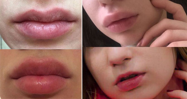 Чем увеличивают губы - характеристики филлеров