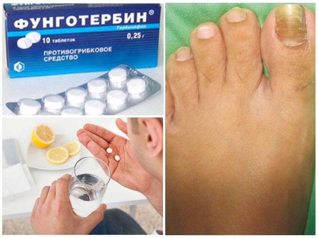 Грибок стопы эффективные препараты. Таблетки от грибка ногтей на ногах. Средство от грибка ногтей на ногах. Средство против грибка стопы.