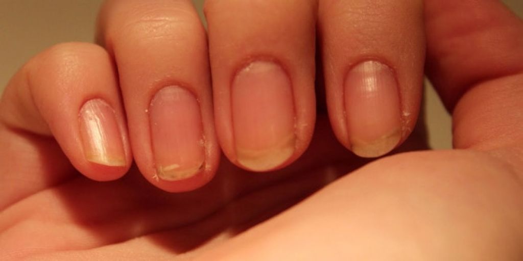 Слоятся ногти: почему ломаются на руках, чего не хватает в организме, каковы причины отслоения, что делать для лечения?