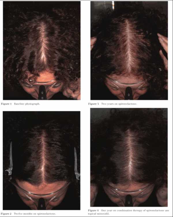 Андрогенное выпадение волос у женщин