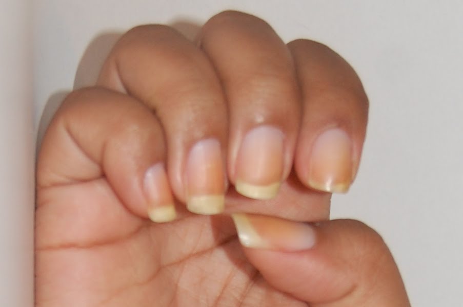 Почему желтеют ногти на руках у женщин и мужчин — причины