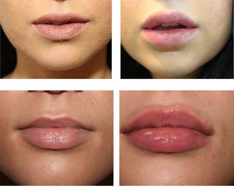 Последствия увеличения губ: ошибки, осложнения после введения филлера в губы