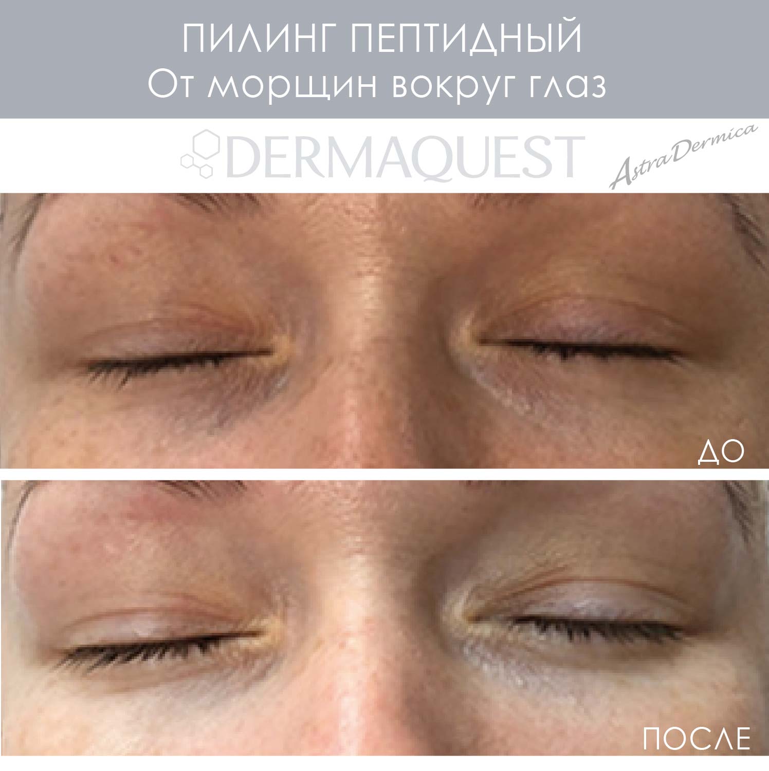 Пептидный пилинг отзывы. Пептидный пилинг DERMAQUEST. Пилинги от морщин вокруг глаз. Химический пилинг под глазами. Пилинг для кожи вокруг глаз.