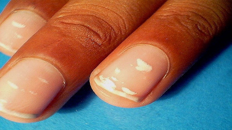 Белые пятна на ногтях: причины возникновения и основные симптомы, способы лечения заболевания