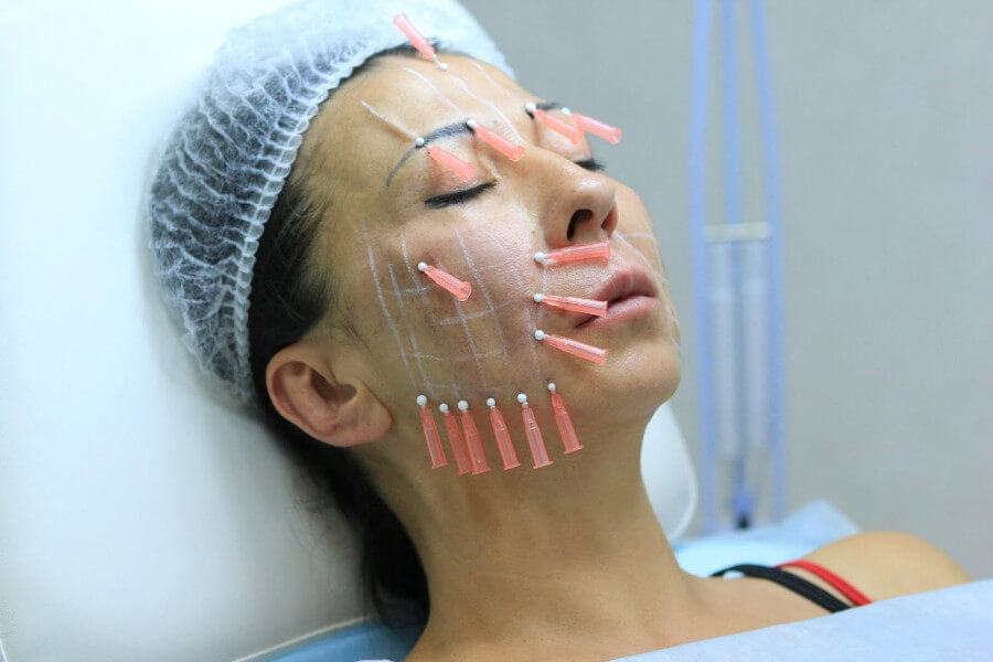 Радиоволновой лифтинг (rf-лифтинг ) кожи лица и тела