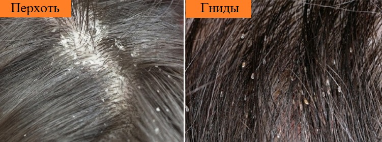 Педикулёз тела - симптомы болезни, профилактика и лечение педикулёза тела, причины заболевания и его диагностика на eurolab