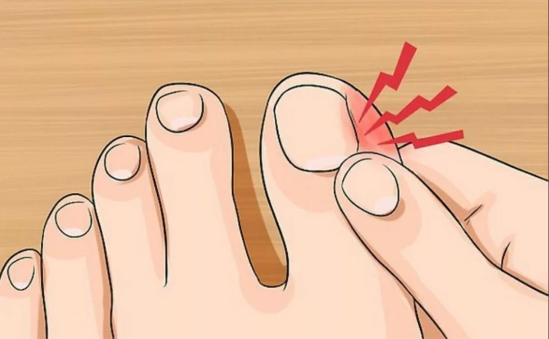 Вросший ноготь на ноге, что делать при вросшем ногте на большом пальце - лечение, удаление проблемы - docdoc.ru