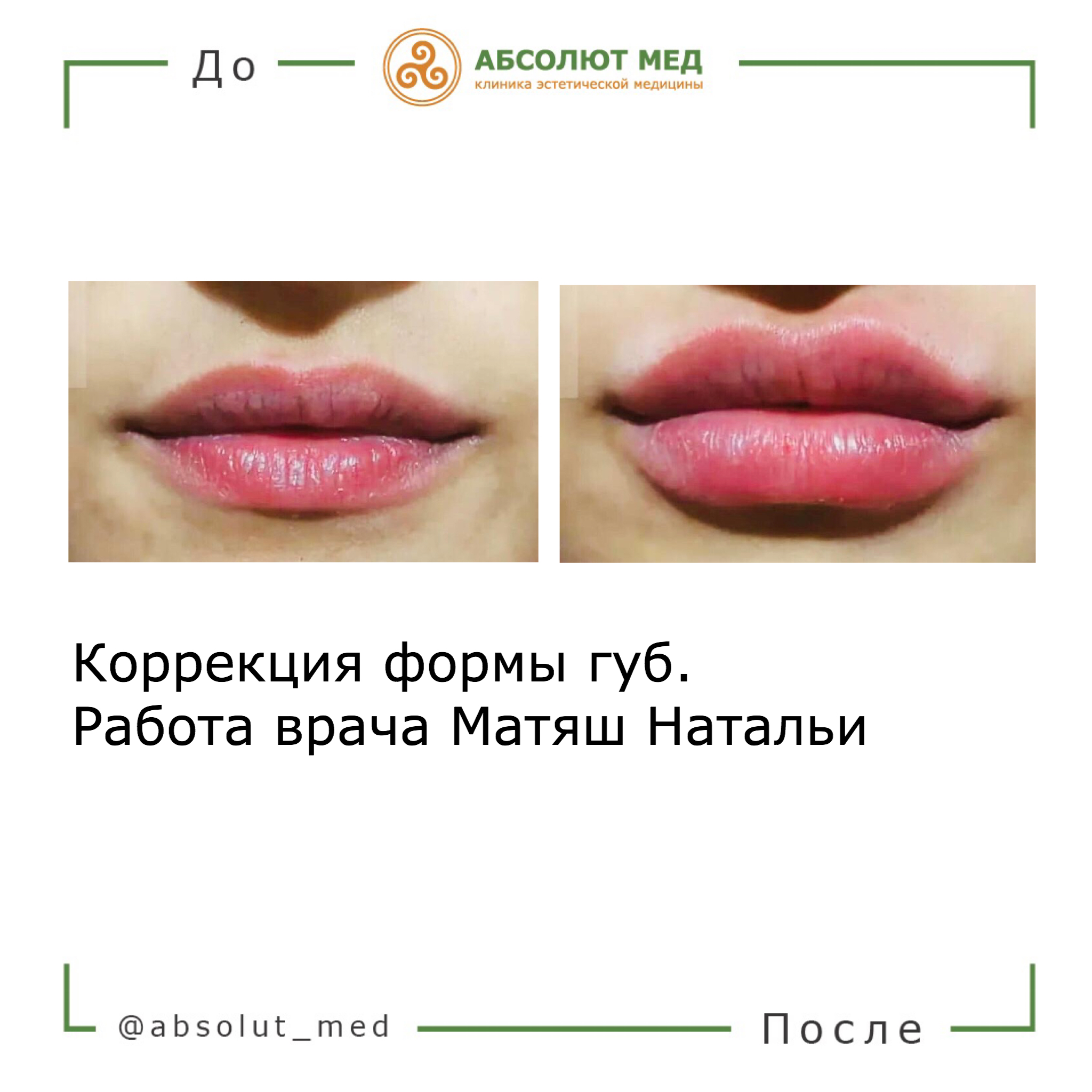 Приложение увеличивающее губы. Форма губ для увеличения. Коррекция формы губ. Натуральная форма губ.