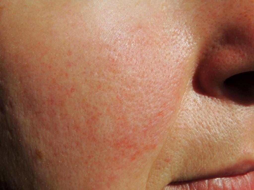 Гиперемия кожи — причины и лечение