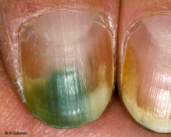 Зеленые ногти - причины, симптомы псевдомонии • журнал nails