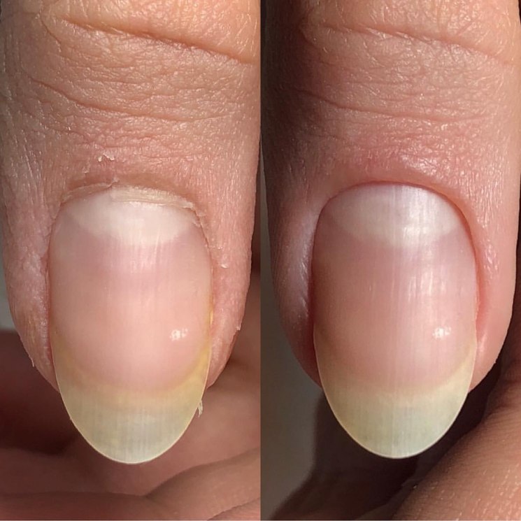 Онихорексис или трещина вдоль ногтя: почему появляется, что делать?