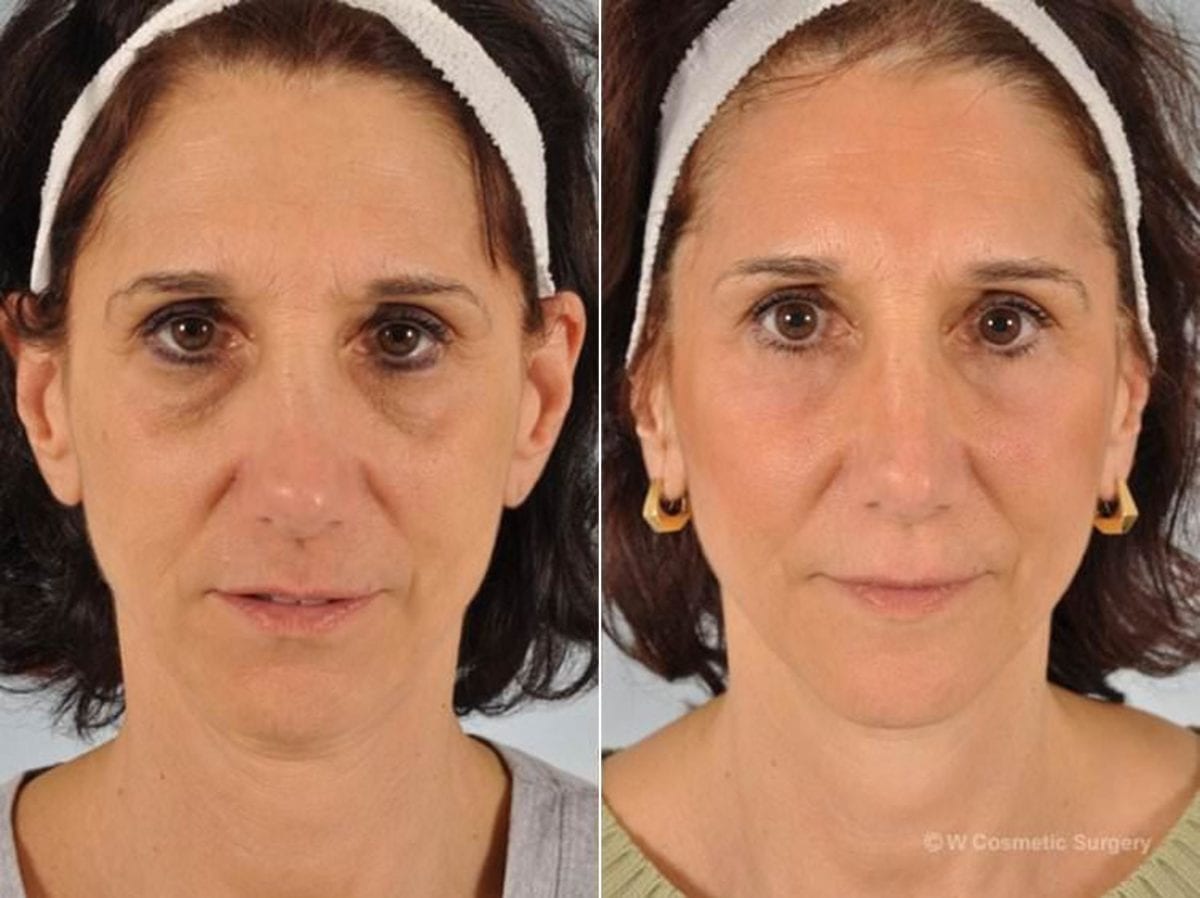 Мезотерапия под глазами фото до и после