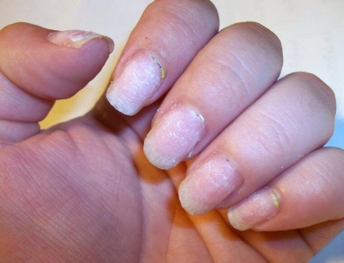 Как восстановить ногти после наращивания: лечение и укрупление