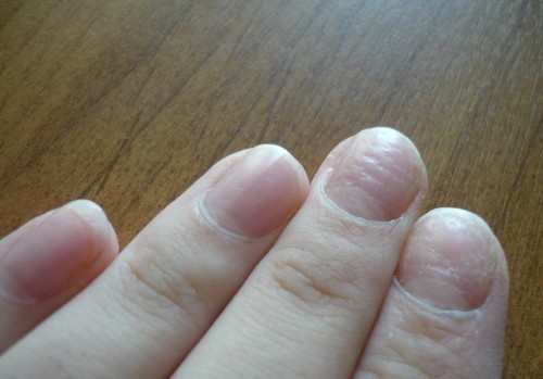 Деформация ногтей на руках причины и лечение. фото и видео болезни