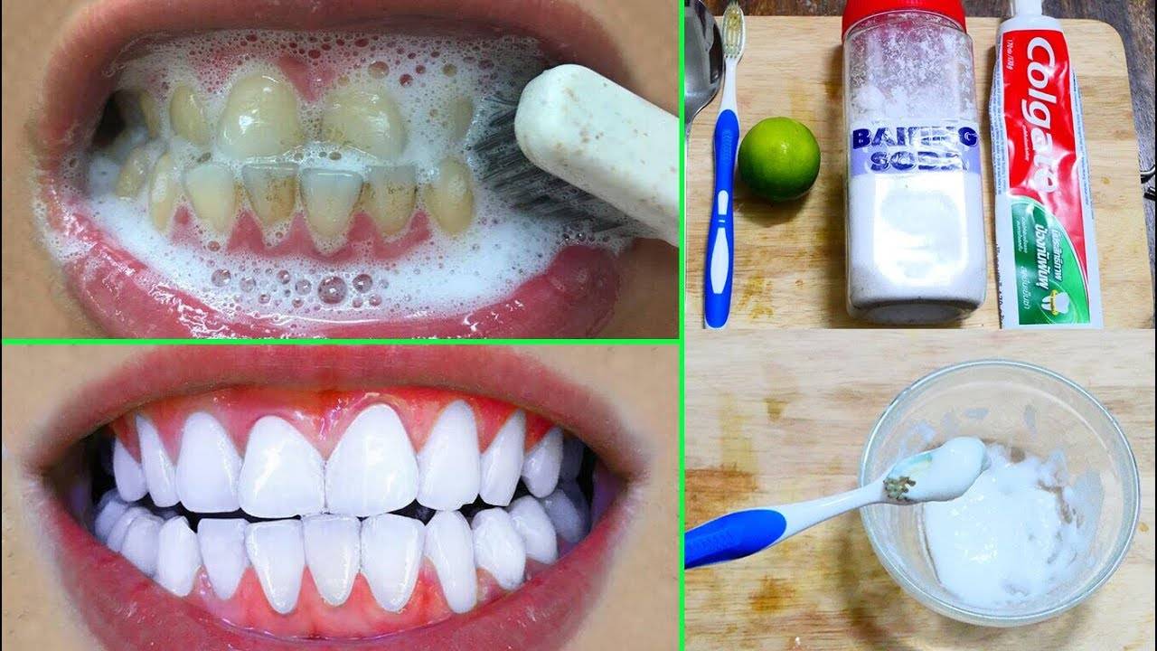 Отбеливание зубов: какие есть способы?