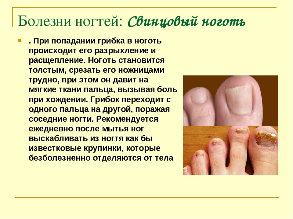 О чем говорит заболевание ногтей. Грибковые болезни ногтей. Грибковые заболевания ногтей рук.
