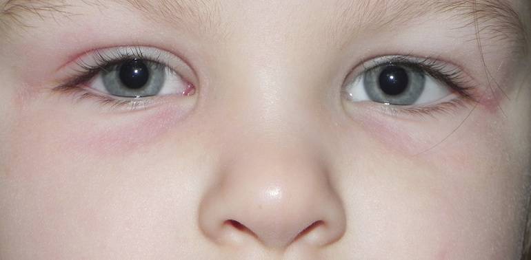 Крапивница у детей: симптомы, лечение | как выглядит крапивница у ребенка, фото