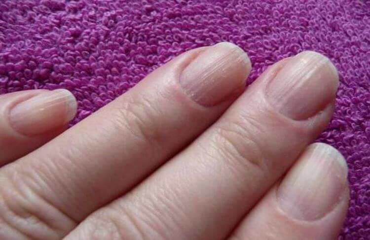 Ногти стали бугристые причины. волнистые ногти на руках: как лечить в домашних условиях