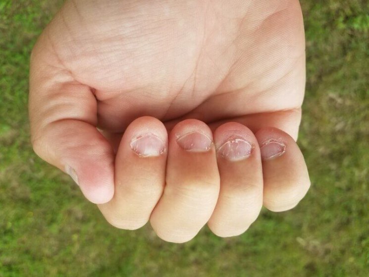 Привычка грызть ногти | блог медицинского центра "анапа-океан"