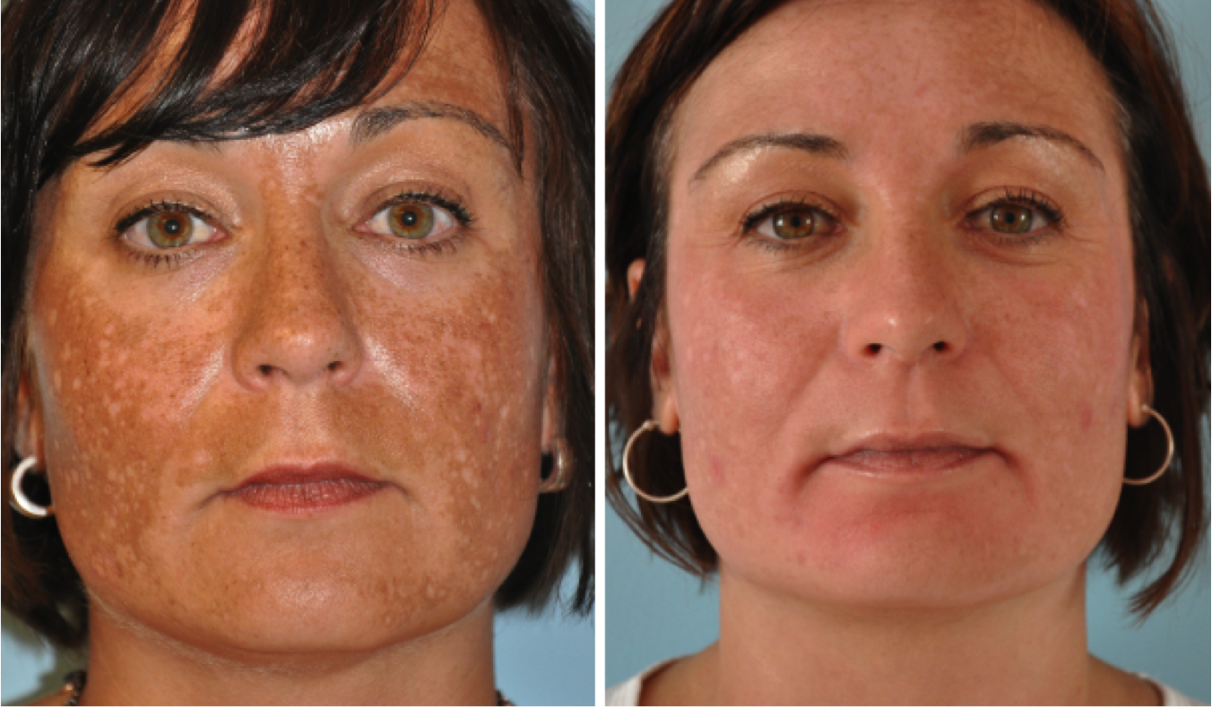 Как восстанавливается кожа. Эрбиевый лазер м22. Химический пилинг. Пигментация на лице до и после.