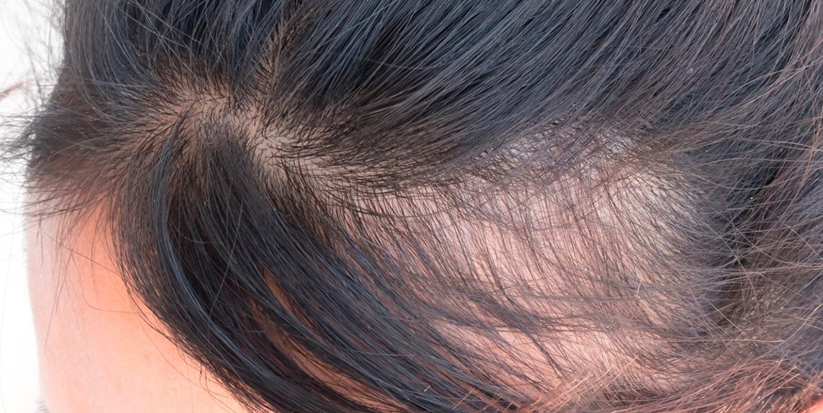 Андрогенная алопеция или выпадение волос по «мужскому типу» — причины и лечение
