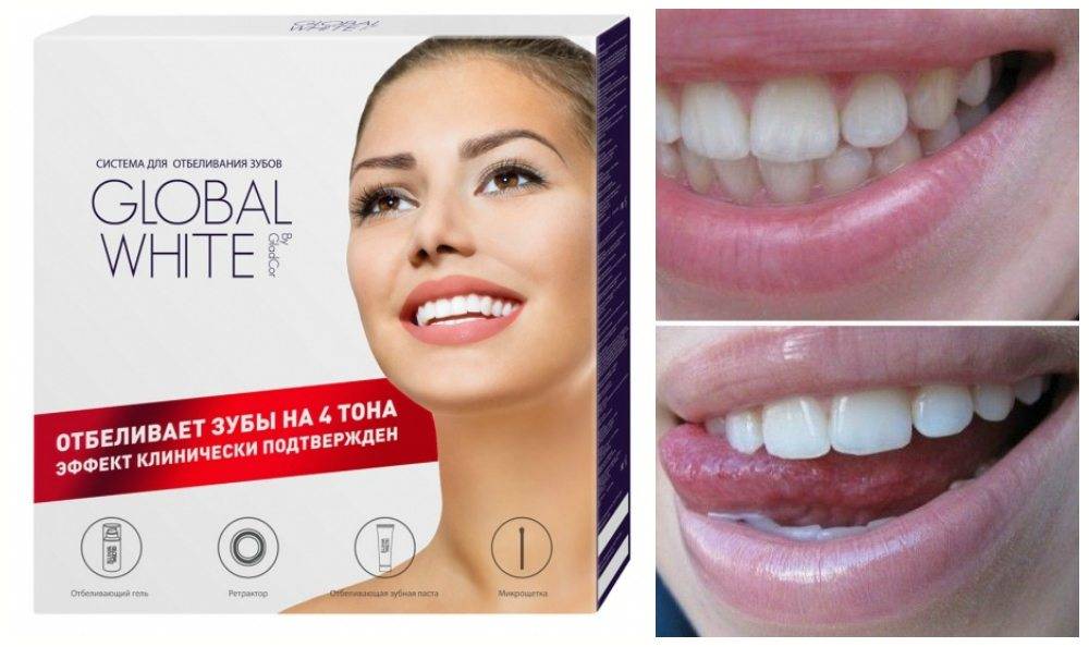 Отбеливание зубов white perfect - твои жемчужные зубы