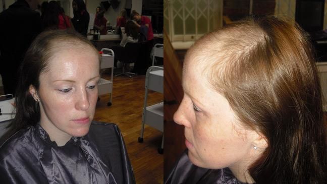 Как восстановиться после родов волосы и кожа