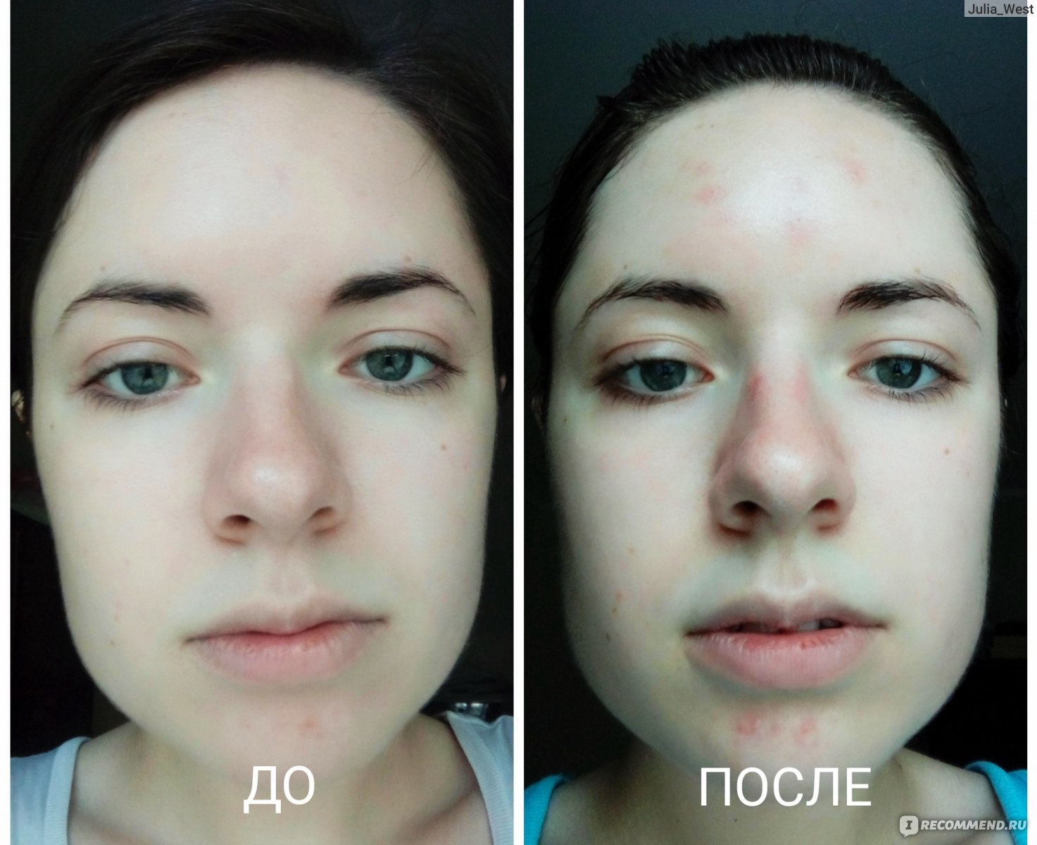 Результаты чистки лица до и после фото