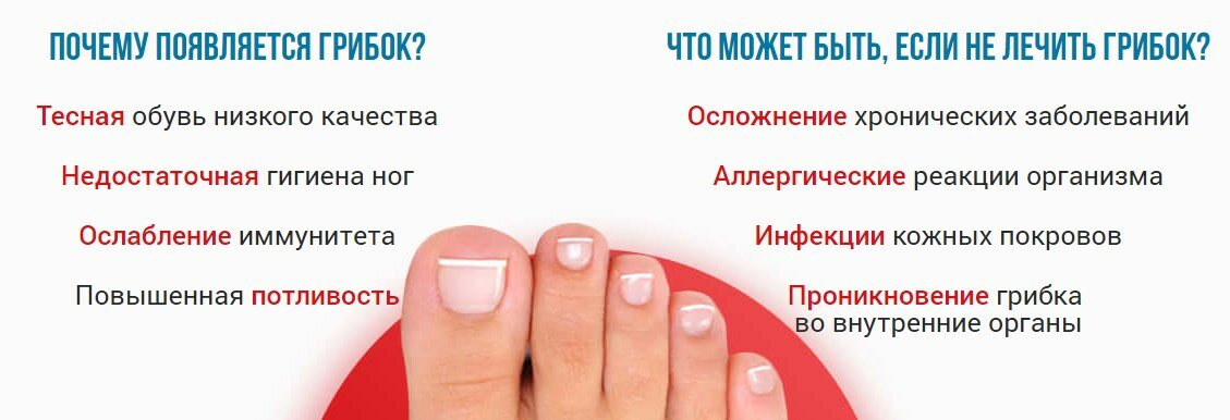 Онихомикоз: советы доктора о профилактике грибка ногтей