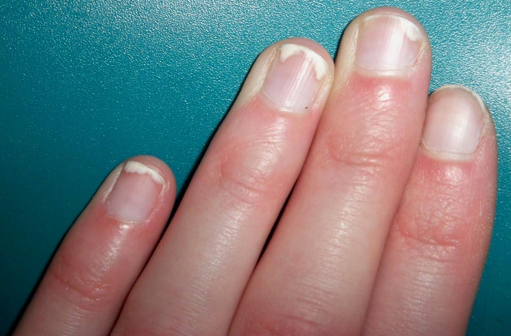 Почему слоятся ногти, и что делать?