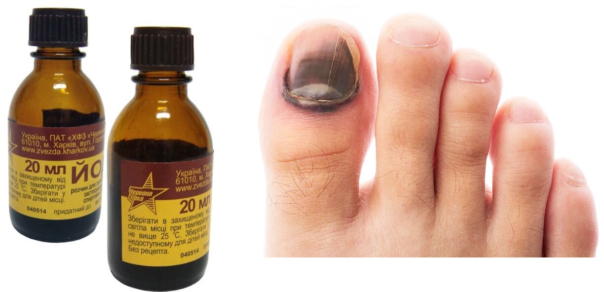 Помогает ли лечение грибка ногтей на ногах йодом - медрег22.рф