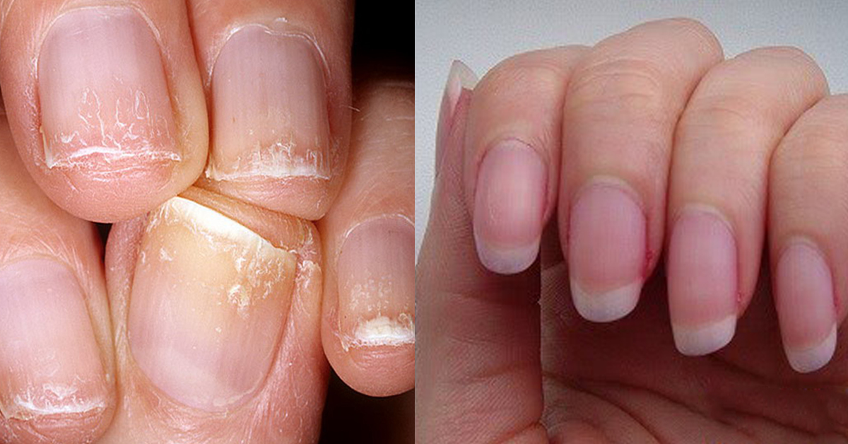 Как быстро восстановить ногти после наращивания в домашних условиях