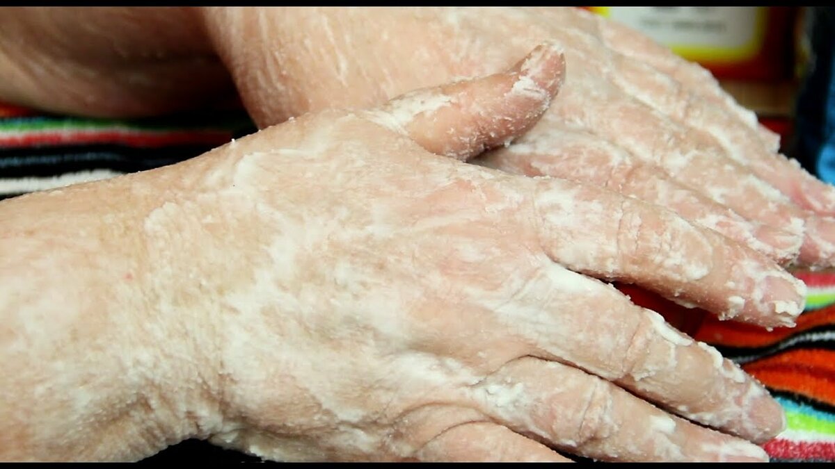 Сухая кожа рук, которая шелушится на ладонях: причины и что делать