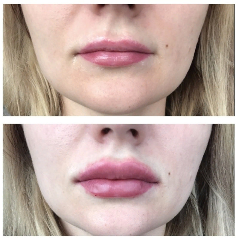 Татуаж или увеличение губ. Перманентный макияж на тонкие губы. Перманент губ до и после. Перманентный макияж губ на тонких губах.