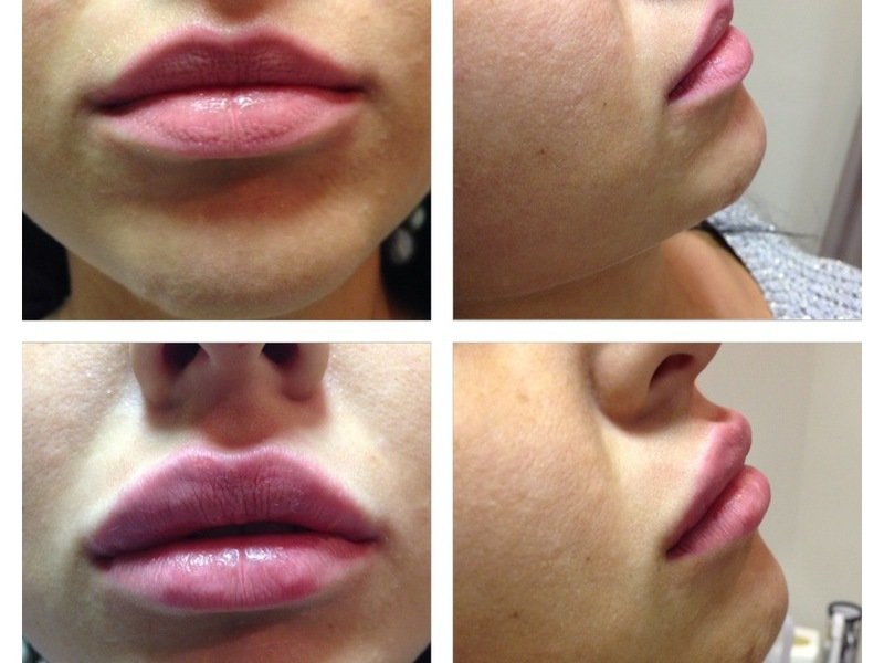 Моделирование губ гиалуроновой кислотой – плотные, влажные, чувственные