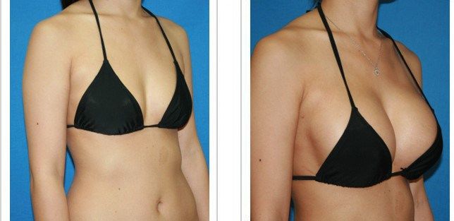 Коррекция груди (молочных желез) в ярославле: фото и отзывы | пластика груди в клинике «константа»